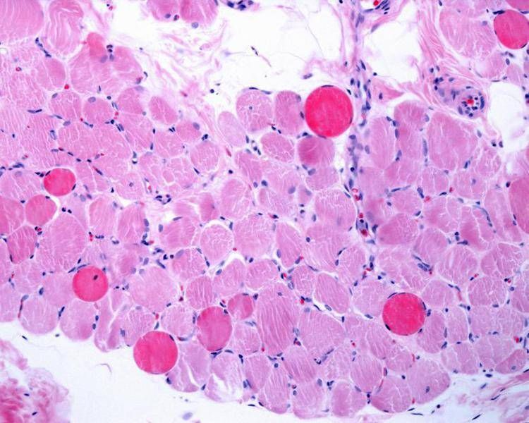 Malattie rare: risultati incoraggianti dopo 5 anni per vamorolone nella distrofia di Duchenne