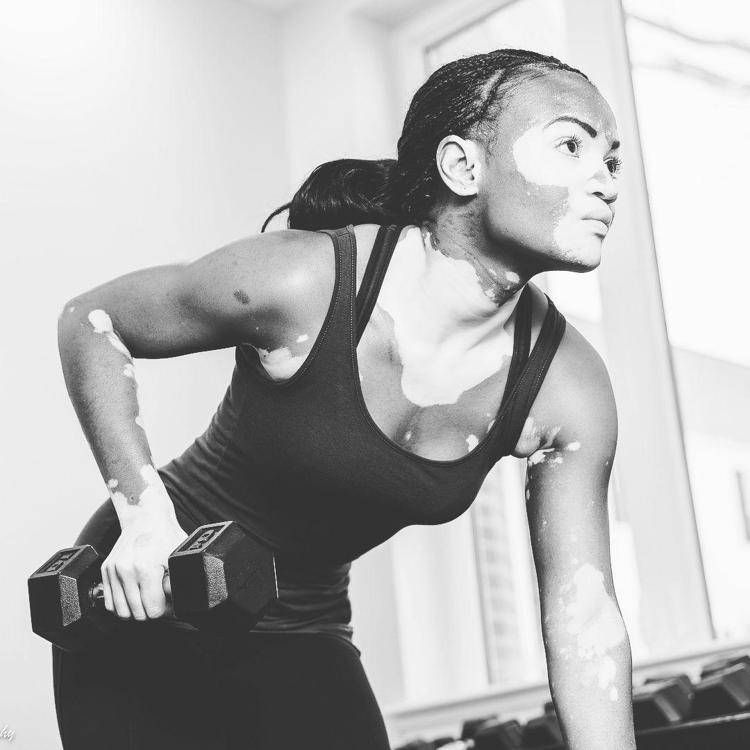 Vitiligine Week: l’importanza della terapia della luce nel trattamento